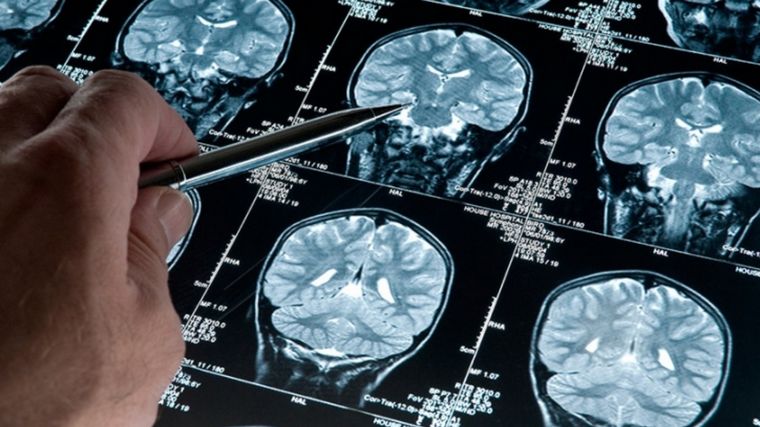 Investigan cómo detectar el alzheimer con inteligencia artificial (Foto: Cambio 2000)