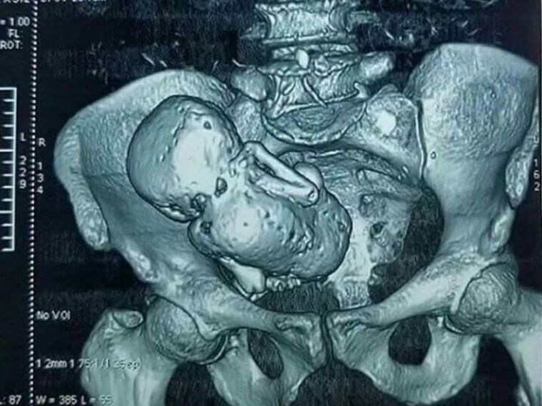 FOTO: Descubren un feto momificado en una mujer de 84 años: llevaba 40 años dentro