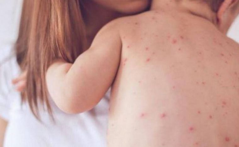 FOTO: El Ministerio de Salud de Salta confirmó un caso de sarampión en un bebé.