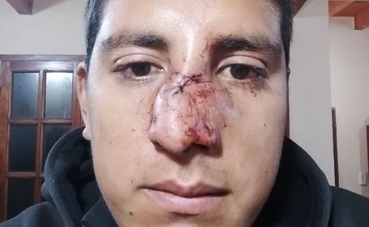  Franco Acosta sufrió la fractura de tabique nasal. 