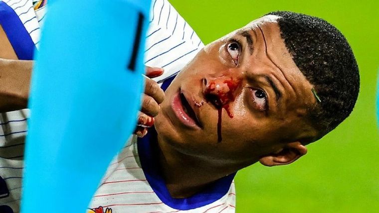 Mbappé se fracturó el tabique y será operado