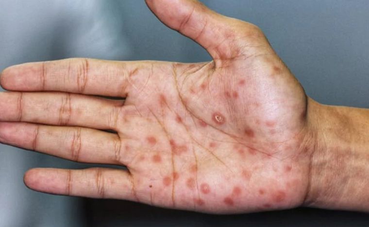 Destacan la importancia de detectar tempranamente los casos de VIH.