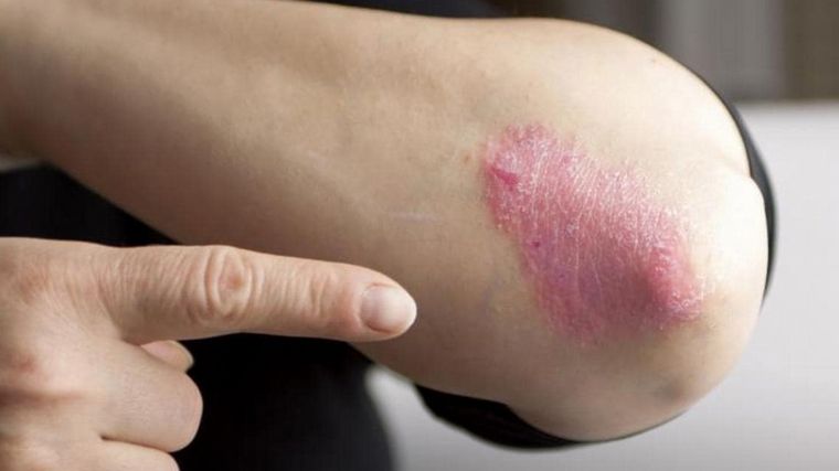 Campaña de detección gratuita de la enfermedad psoriásica