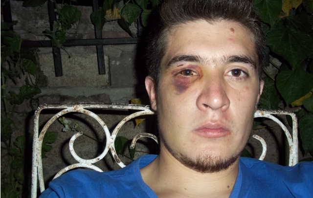 Matías Basavilvazo recibió un fuerte golpe en su ojo derecho.