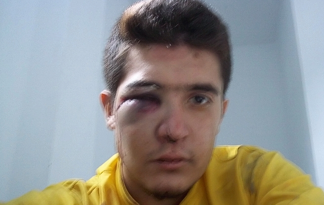 Matías Basavilvazo, de 23 años, recibió un fuerte golpe en su ojo derecho.