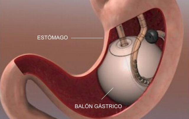 Así funciona el balón gástrico.