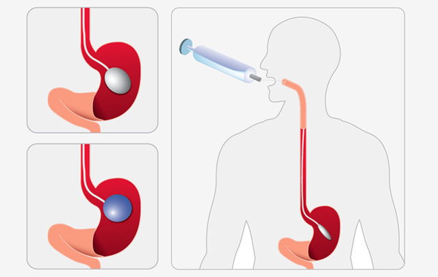 Así funciona el balón gástrico.