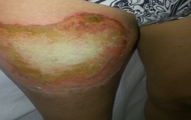 FOTO: La muchacha sufrió quemaduras en su pierna derecha.