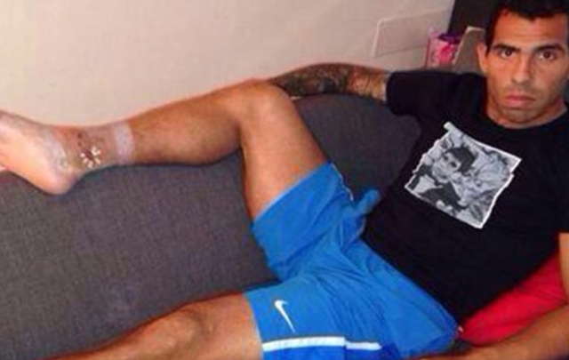 Así le quedó el tobillo a Tevez tras la terrible falta.