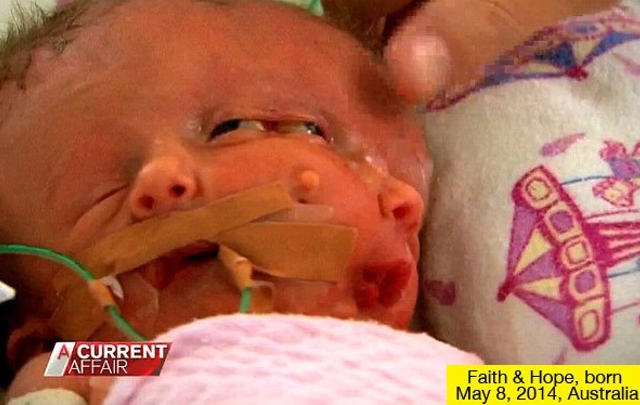 Las mellizas también comparten el corazón, el cuerpo y las extremidades.