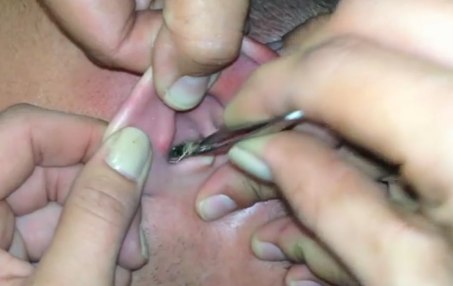 El desesperado intento por sacar a la polilla del oído.