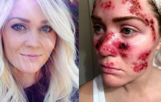 Willoughby sufre de cáncer de piel y busca alertar sobre el uso de la cama solar.