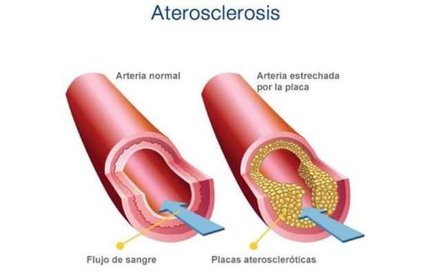 Aterosclerosis (Tabaco o salud)