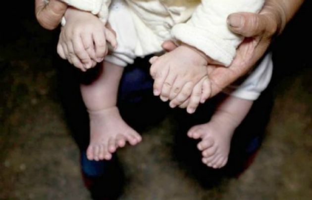 Las manos y los pies del bebé con 31 dedos.