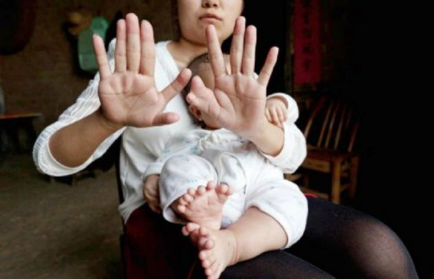 Las manos y los pies del bebé con 31 dedos.