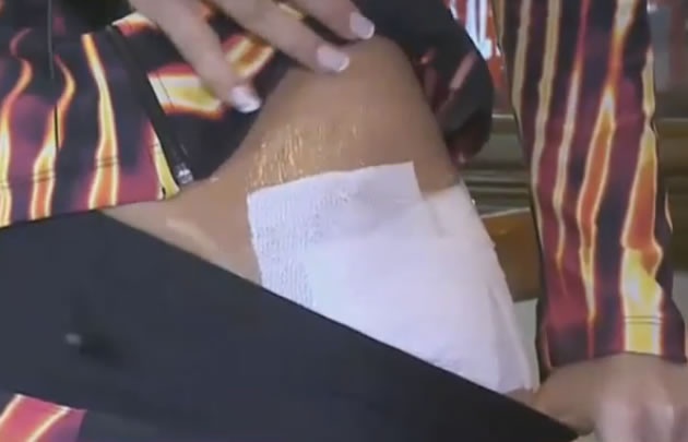 Iliana Calabró mostró sus quemaduras.