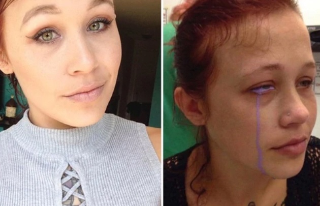Se tatuó el globo ocular y podría quedar ciega de un ojo.