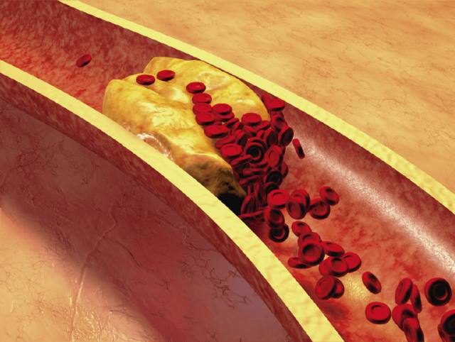 FOTO: Colesterol y arterias: una relación polémica