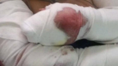 La atacaron tres perros en Punta Mogotes: está en terapia