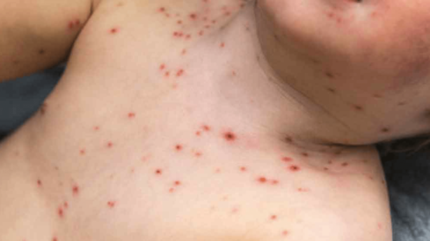 FOTO: Alerta epidemiológico por dos casos autóctonos de sarampión