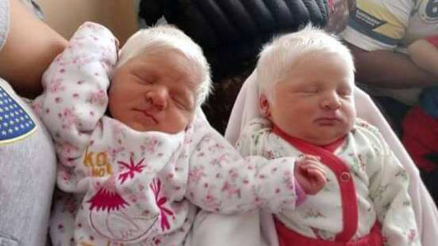 FOTO: Nacieron mellizas albinas en Tucumán
