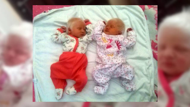 FOTO: Nacieron mellizas albinas en Tucumán