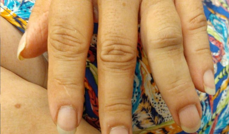 Norma Moreno sufrió fractura de la falange de uno de sus dedos de la mano.