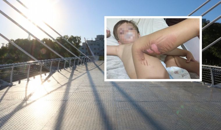 Se quemó con la chapa caliente del puente peatonal.