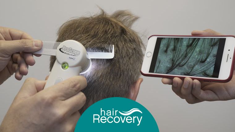 Paso a paso: trasplantes capilares sin cicatriz visible