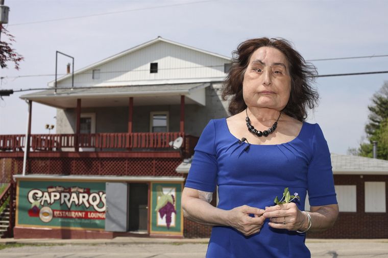 A los 57 años murió la mujer que recibió el mayor trasplante facial. 