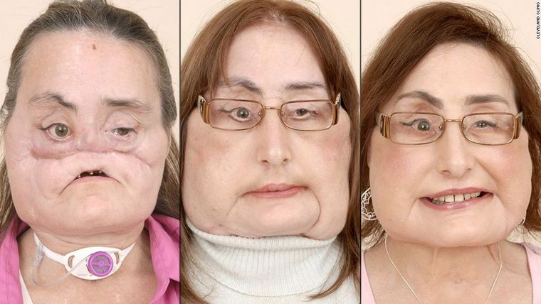 A los 57 años murió la mujer que recibió el mayor trasplante facial. 