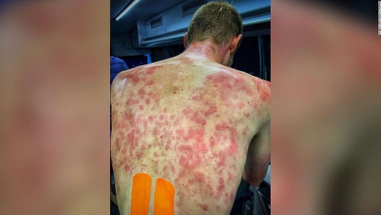 Los ciclistas terminaron con impresionantes marcas en la espalda