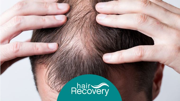 Artas: inteligencia artificial para recuperar el pelo