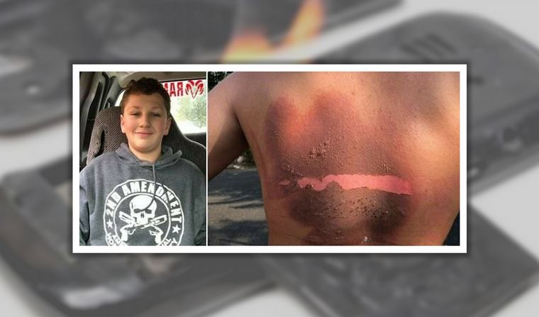 Sufrió quemaduras al explotarle el celular.