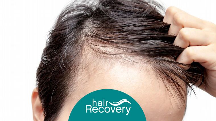 Microtrasplante capilar: rápido, efectivo y sin dolor