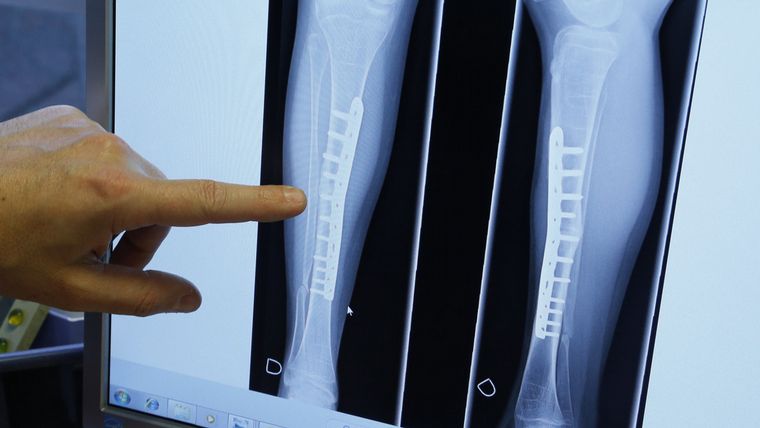 Los veganos y vegetarianos son más propensos a fracturas