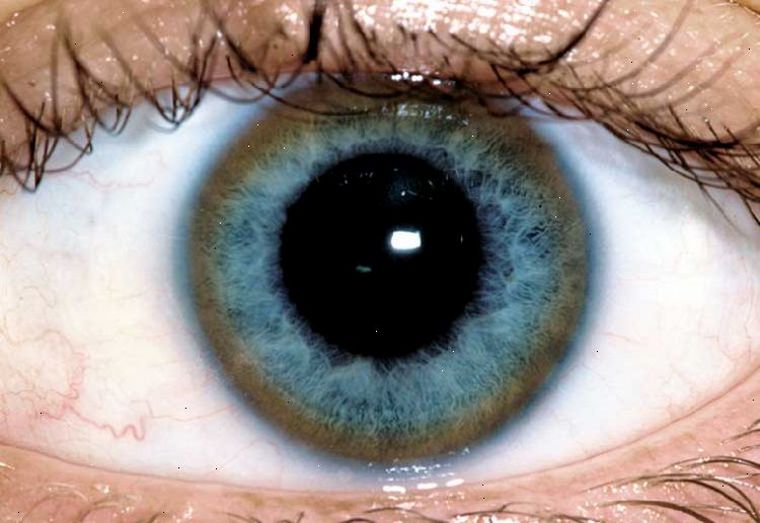 Anillo de Kayser-Fleischer visto en la enfermedad de Wilson.