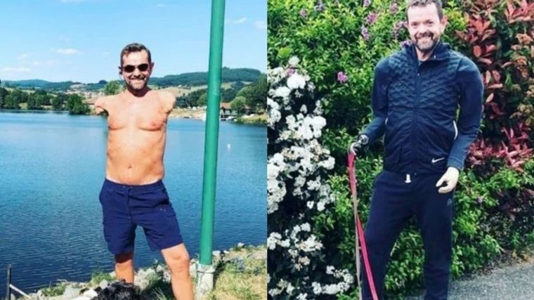 Realizaron con éxito el primer trasplante de brazos.