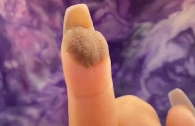 FOTO: Tras un injerto de piel asegura que le crece pelo púbico en el dedo