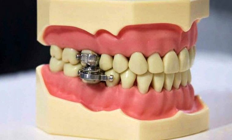 Imagen del ''candado'' dental.