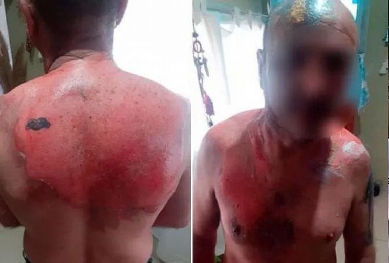 Hombre denunció que fue atacado por su ex con agua hirviendo (Foto: Contexto Tucumán)