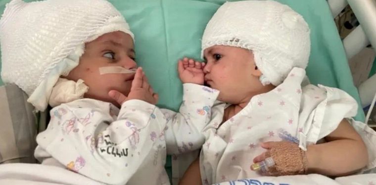 Separan con éxito a gemelas unidas por la cabeza