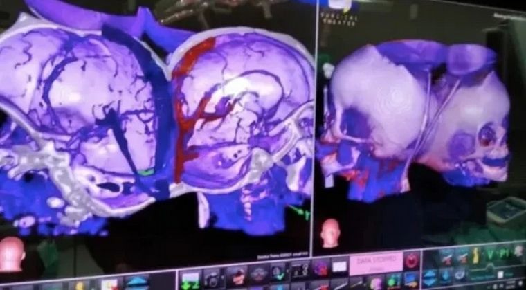 Separan con éxito a gemelas unidas por la cabeza
