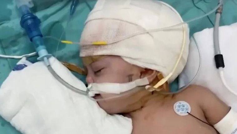 Separan con éxito a gemelas unidas por la cabeza