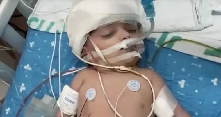 Separan con éxito a gemelas unidas por la cabeza