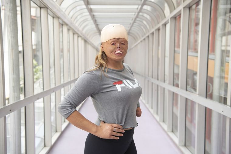 Brisa se quemó el 80% de su cuerpo, hoy es modelo y deportista