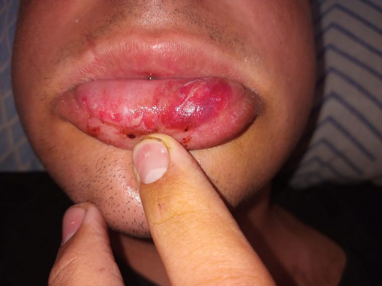 Las lesiones que sufrieron los denunciantes.