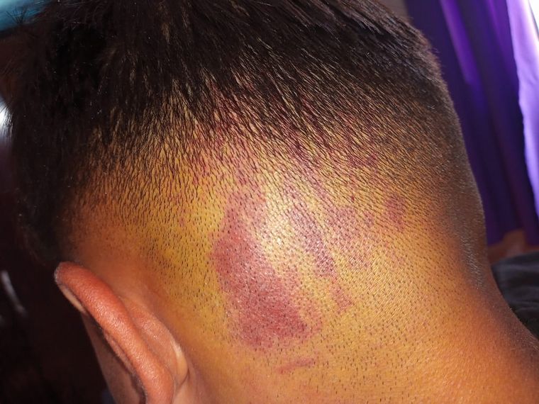 Las lesiones que sufrieron los denunciantes.