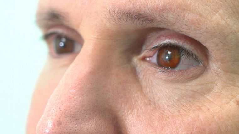 FOTO: Steve Verze recibió una prótesis  ocular impresa en 3D