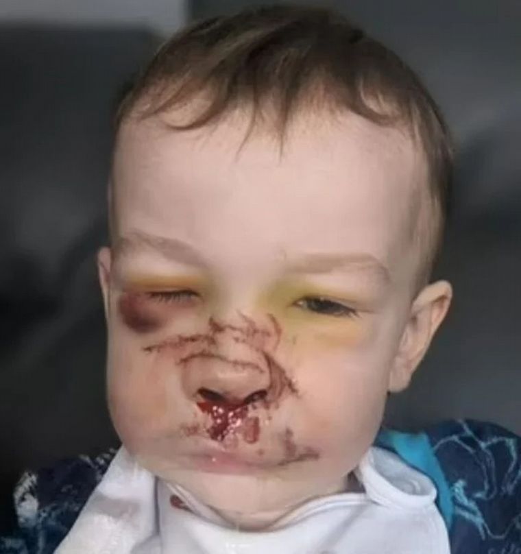 FOTO: Un Bull terrier le destrozó la cara de un mordisco a un bebé